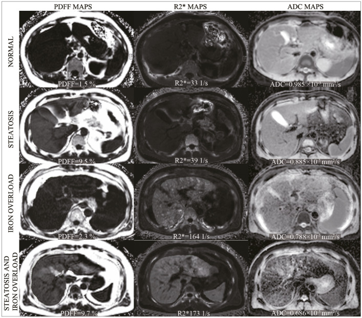 Fat- and iron-corrected ADC to assess liver fibrosis in patients with chronic hepatitis B.
