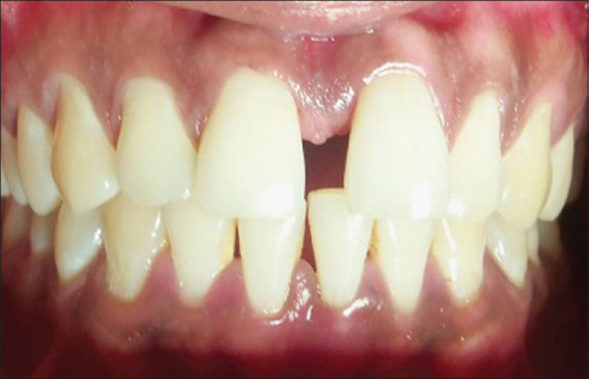 Assessment of Serum Parameters in Stable Coronary Artery Disease Patients in Correlation with Healthy and Chronic Periodontitis Patients.