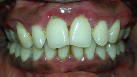 Assessment of Serum Parameters in Stable Coronary Artery Disease Patients in Correlation with Healthy and Chronic Periodontitis Patients.
