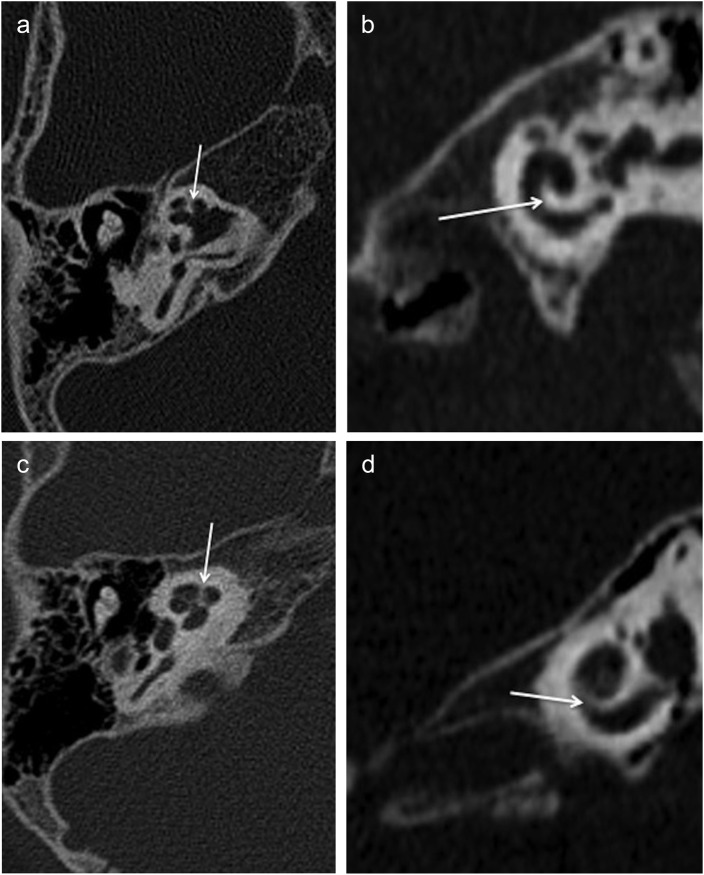 X-linked deafness/incomplete partition type 3: Radiological evaluation of temporal bone and intracranial findings.