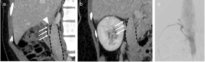 Techniques in adrenal vein sampling: Multipurpose catheter shape facilitates sampling of cranially oriented right adrenal veins.