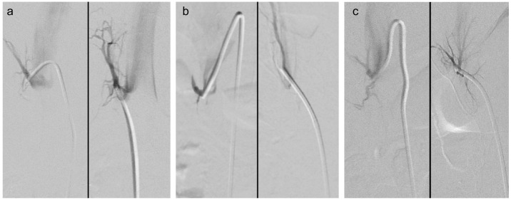 Techniques in adrenal vein sampling: Multipurpose catheter shape facilitates sampling of cranially oriented right adrenal veins.