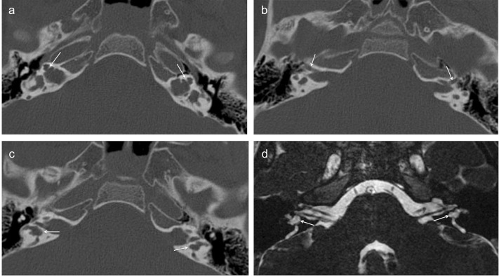 X-linked deafness/incomplete partition type 3: Radiological evaluation of temporal bone and intracranial findings.