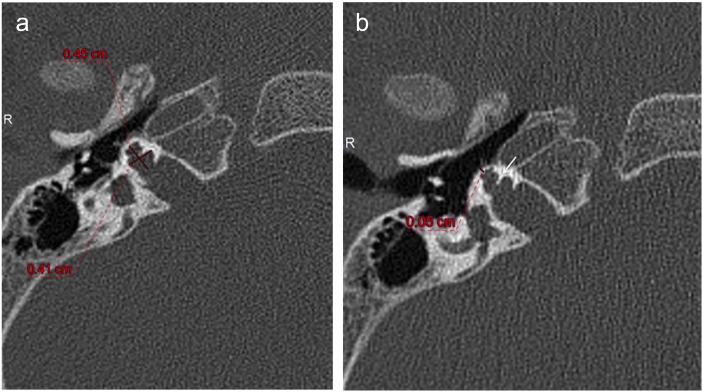 X-linked deafness/incomplete partition type 3: Radiological evaluation of temporal bone and intracranial findings.