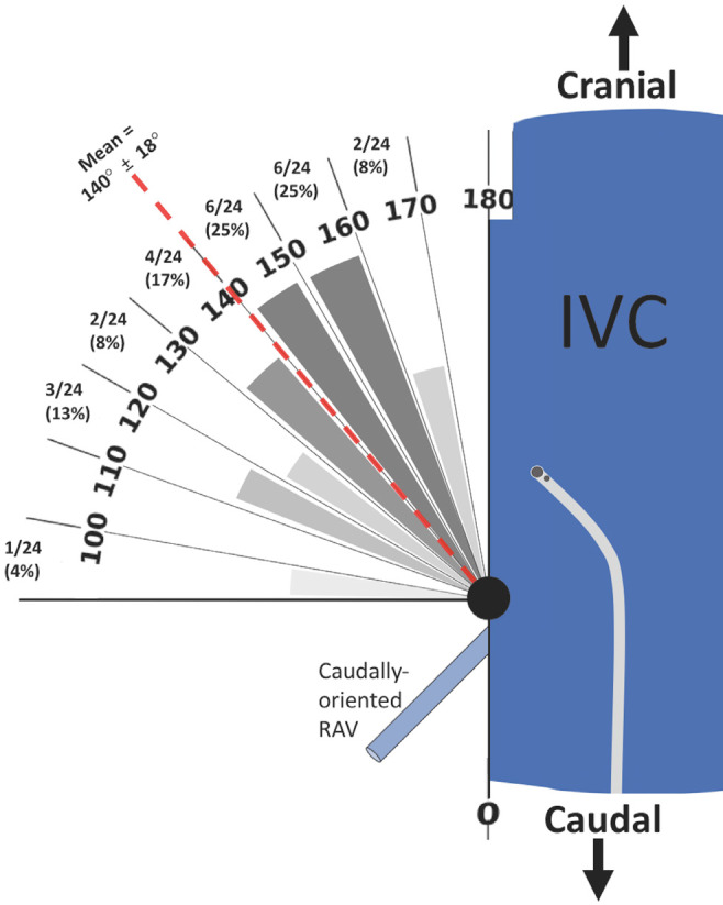 Techniques in adrenal vein sampling: Multipurpose catheter shape facilitates sampling of cranially oriented right adrenal veins.