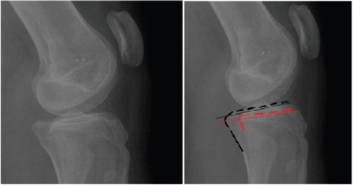 Tibial slope changes following guided growth by the eight-plate: A retrospective comparative study.