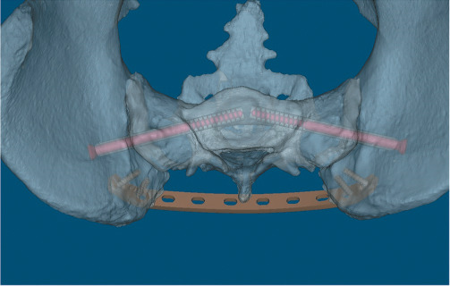 Preliminary results of iliosacral screws and plate combination in the management of tile B3 pelvic fractures: A retrospective case series.