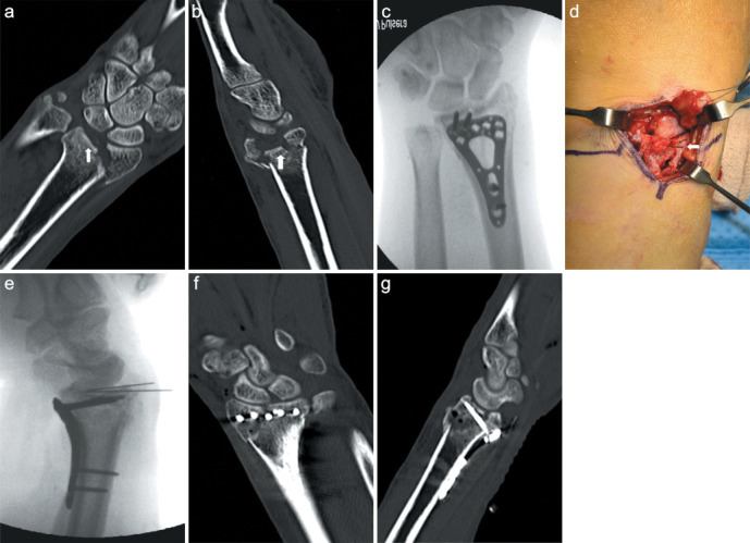 Dorsal plating versus volar plating with limited dorsal open reduction in the management of AO type C3 distal radius fractures with impacted articular fragments: A retrospective comparative study.