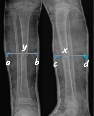 Analysis of risk factors for re-displacement of pediatric tibia fractures: A retrospective study of 196 cases.