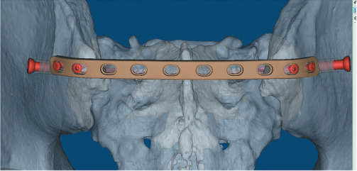Preliminary results of iliosacral screws and plate combination in the management of tile B3 pelvic fractures: A retrospective case series.