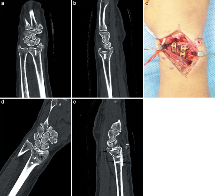Dorsal plating versus volar plating with limited dorsal open reduction in the management of AO type C3 distal radius fractures with impacted articular fragments: A retrospective comparative study.