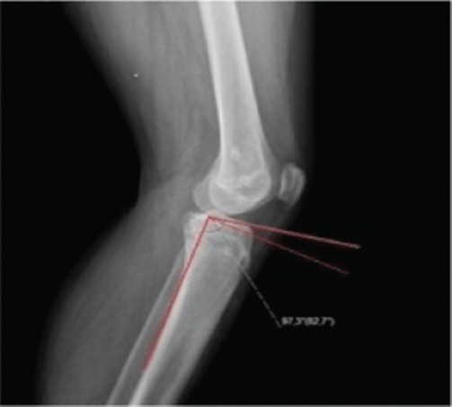 Tibial slope changes following guided growth by the eight-plate: A retrospective comparative study.
