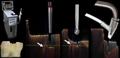 Optical coherence tomography evaluation of deep dentin crack removal techniques