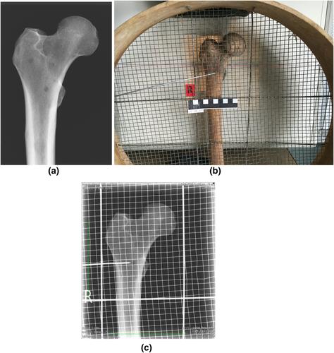 Employing radiography (X-rays) to localize lesions in human skeletal remains from past populations to allow accurate biopsy, using examples of cancer metastases