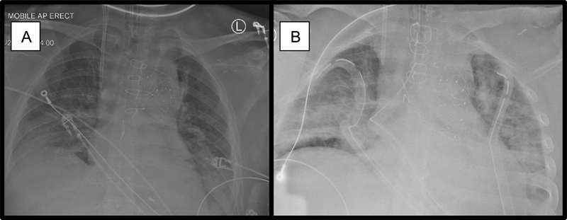 Fulminant Herpes Pneumonia Postaortic Surgery with Known Ankylosing Spondylitis.