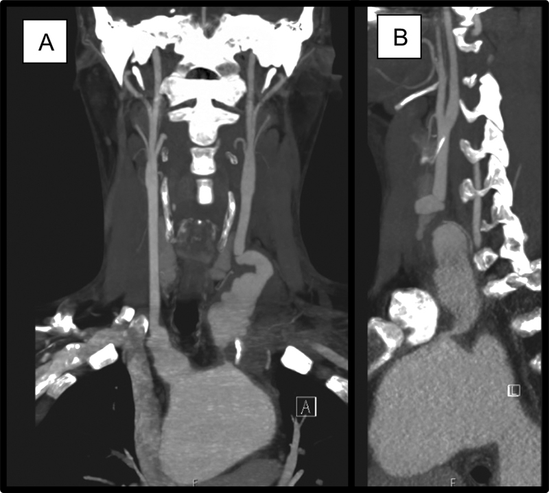 Fulminant Herpes Pneumonia Postaortic Surgery with Known Ankylosing Spondylitis.