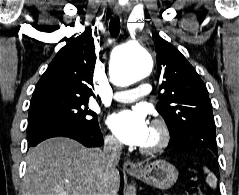 Fulminant Herpes Pneumonia Postaortic Surgery with Known Ankylosing Spondylitis.