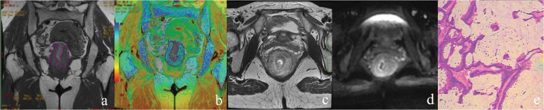 Quantitative T2 Mapping to Discriminate Mucinous from Nonmucinous Adenocarcinoma in Rectal Cancer: Comparison with Diffusion-weighted Imaging.