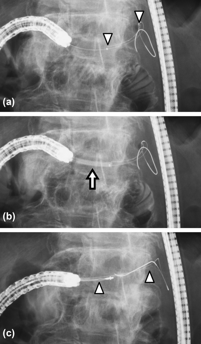 Successful endoscopic retrieval of a proximally migrated pancreatic stent in a patient with pancreaticojejunal anastomotic stenosis.