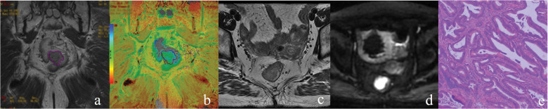 Quantitative T2 Mapping to Discriminate Mucinous from Nonmucinous Adenocarcinoma in Rectal Cancer: Comparison with Diffusion-weighted Imaging.