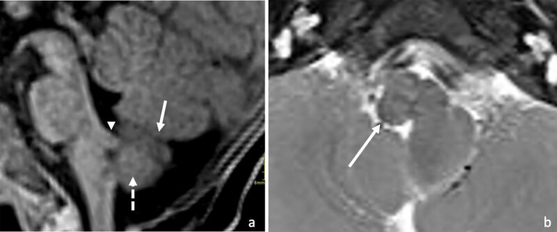 Supernumerary Heterotopic Hemicerebellum: A Rare Case of an Accessory Mass in the Posterior Fossa.