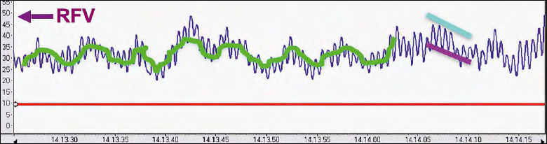 Free flaps monitoring by Laser-Doppler Flowmetry in head and neck surgery.