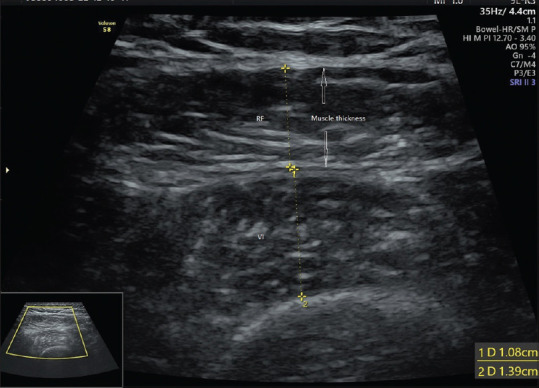 Ultrasonography for Assessment of Sarcopenia: A Primer.