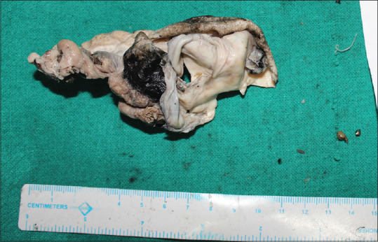 Serous Cystadenoma with Ectopic Adrenal Cell Rest of Ovary: A Rare Case Report.