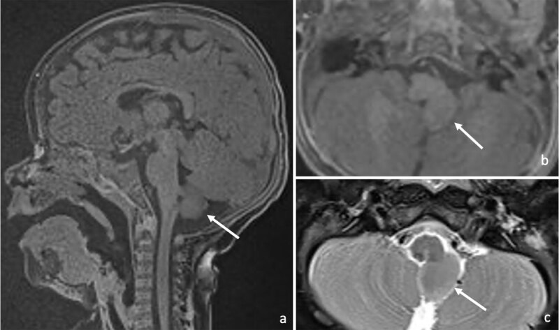 Supernumerary Heterotopic Hemicerebellum: A Rare Case of an Accessory Mass in the Posterior Fossa.