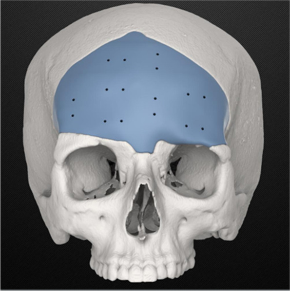 Our problems and observations in 3D facial implant planning.