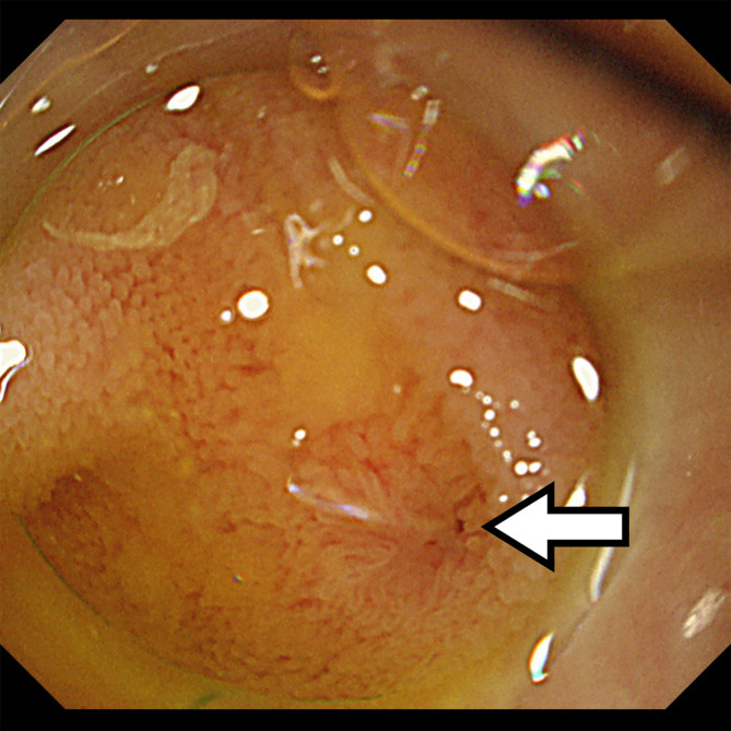 Successful endoscopic retrieval of a proximally migrated pancreatic stent in a patient with pancreaticojejunal anastomotic stenosis.