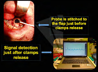 Free flaps monitoring by Laser-Doppler Flowmetry in head and neck surgery.