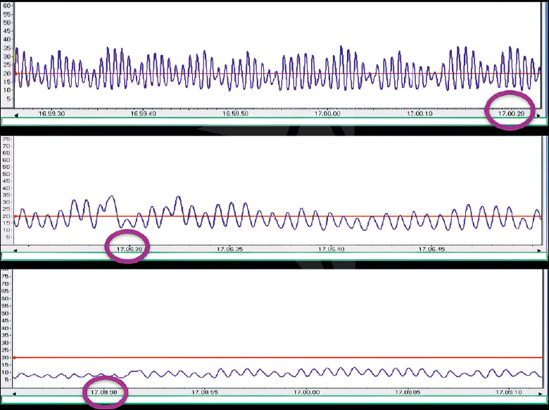 Free flaps monitoring by Laser-Doppler Flowmetry in head and neck surgery.