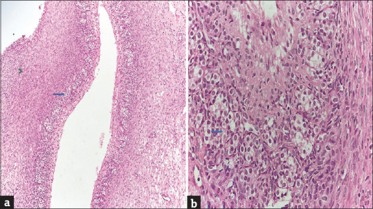 Serous Cystadenoma with Ectopic Adrenal Cell Rest of Ovary: A Rare Case Report.