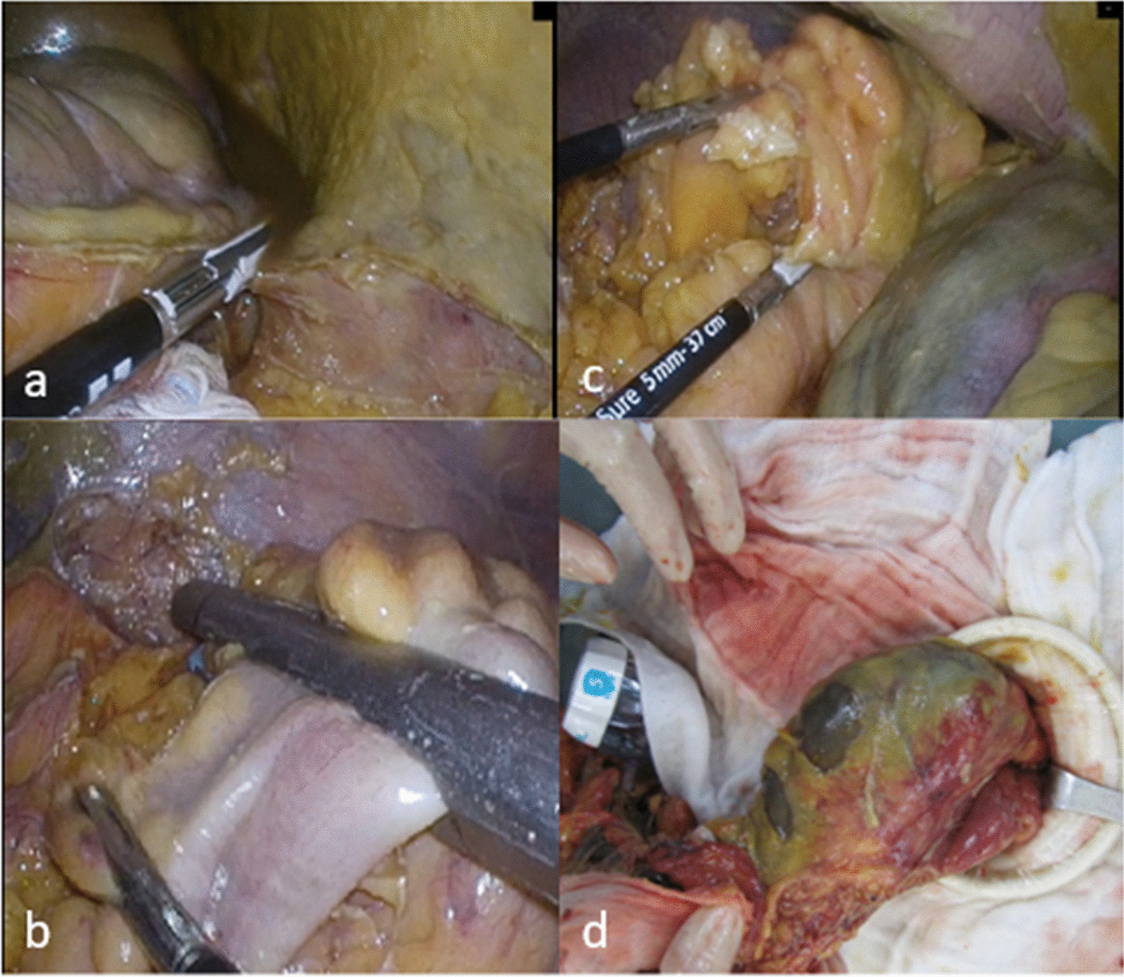 Laparoscopic versus open emergent colectomy for ischemic colitis: a propensity score-matched comparison.