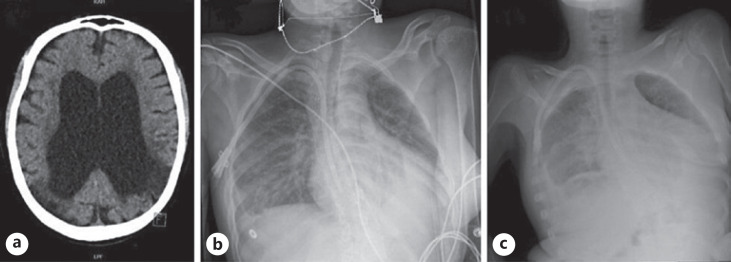 Undetected Iatrogenic Drug-Induced Complications in a Hemodialyzed Anuric Patient: A Case Report and Review of the Literature.