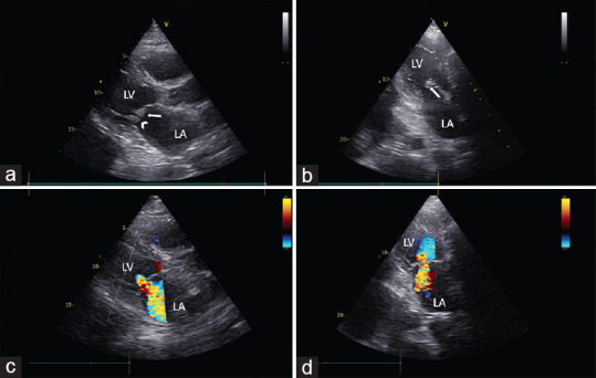 Nonbacterial Thrombotic Endocarditis with Atypical Presentation as Overt Congestive Heart Failure.