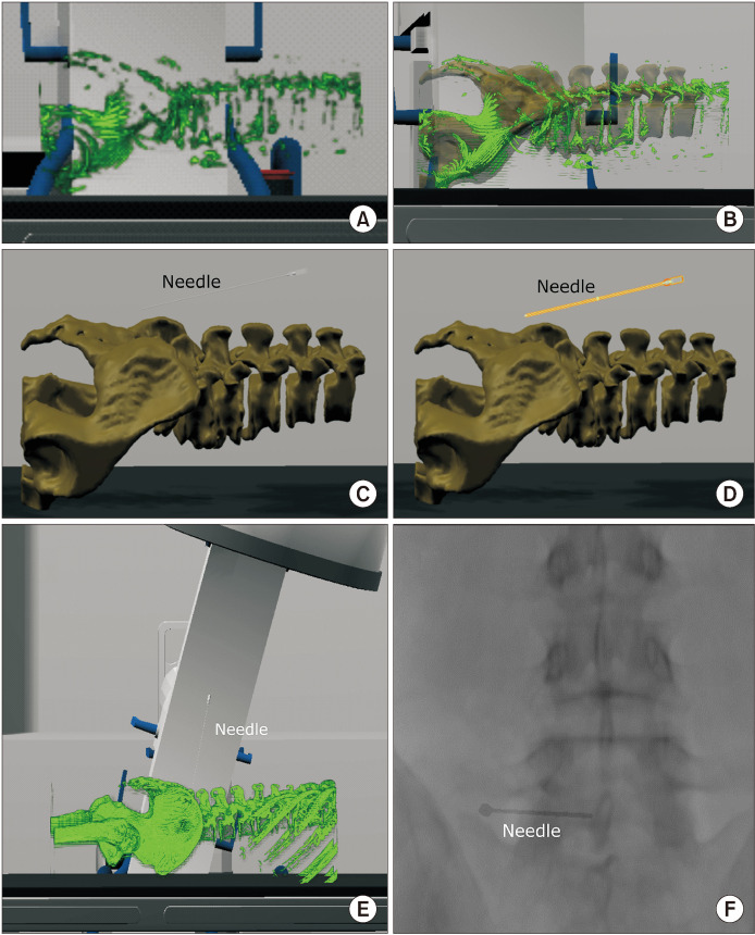 Development of pre-procedure virtual simulation for challenging interventional procedures: an experimental study with clinical application.