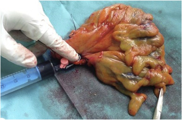 Improved Accuracy of Lymph Node Staging and Long-Term Survival Benefit in Colorectal Cancer With <i>Ex Vivo</i> Arterial Methylene Blue Infiltration.