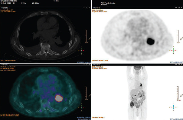 Nonbacterial Thrombotic Endocarditis with Atypical Presentation as Overt Congestive Heart Failure.