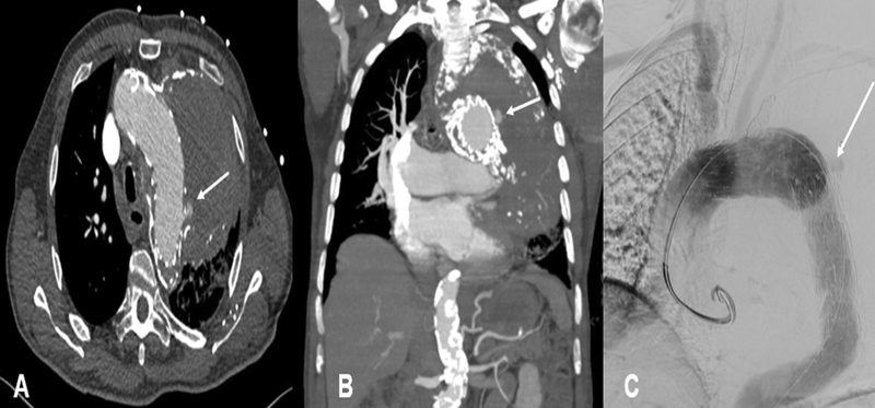 Urgent Pneumonectomy as a Result of an Endoleak Type III-A Late Complication after Aortic Stent Implantation.