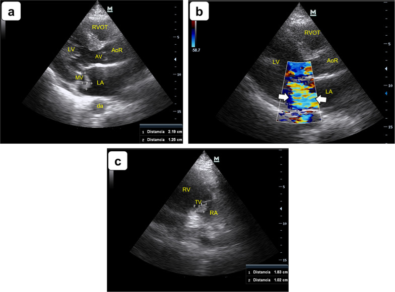 Native-valve endocarditis detected by point-of-care echocardiography.