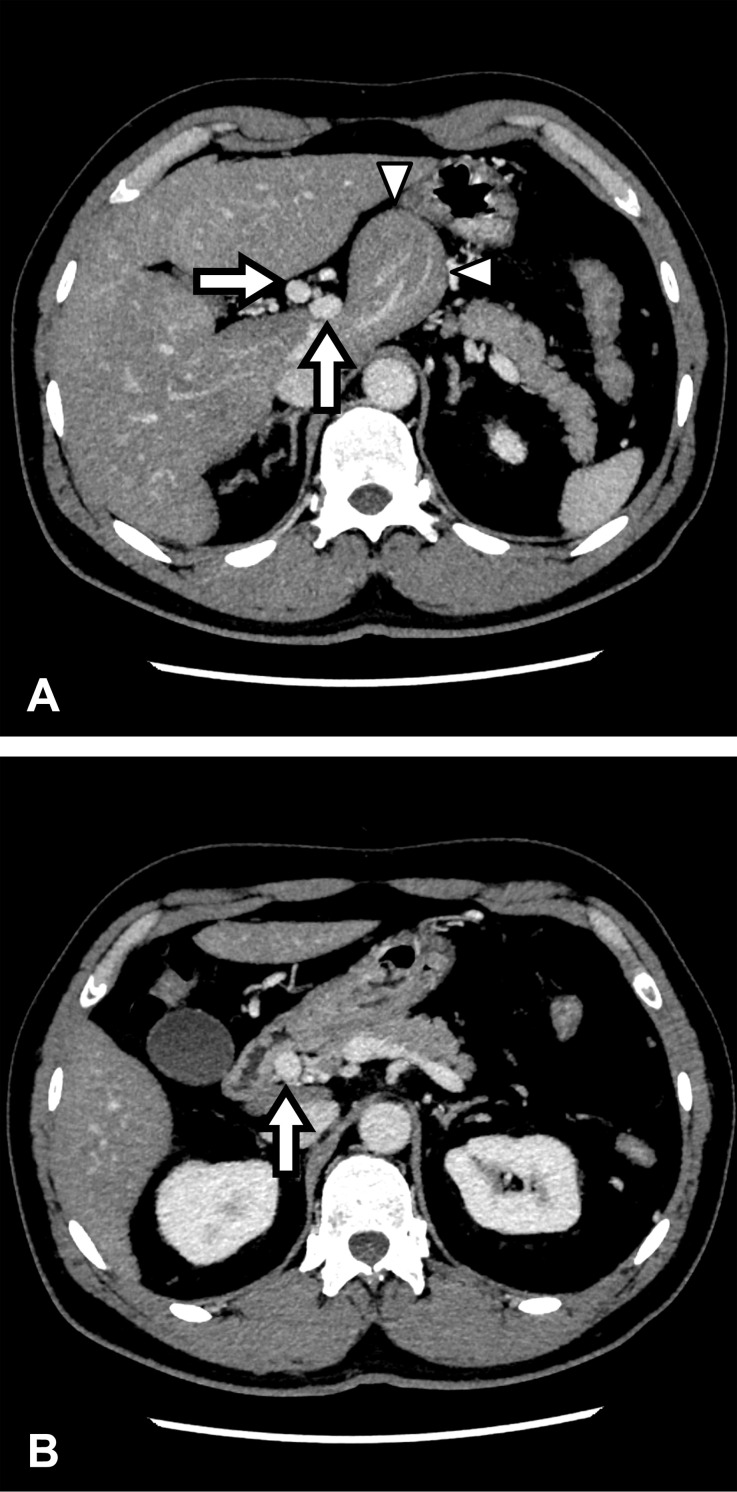 Anomalous duplication of the portal vein with prepancreatic postduodenal portal vein.