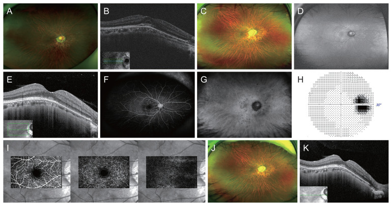 Multiple Evanescent White Dot Syndrome with Submacular Fluid in Dome-shaped Macula Following COVID-19 Vaccination: A Case Report.