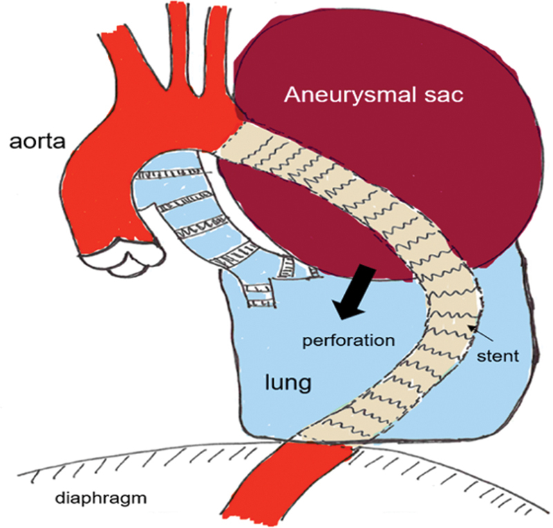 Urgent Pneumonectomy as a Result of an Endoleak Type III-A Late Complication after Aortic Stent Implantation.