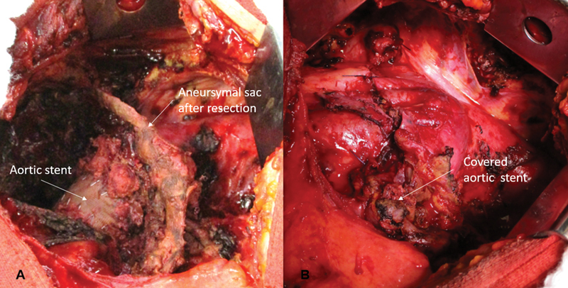 Urgent Pneumonectomy as a Result of an Endoleak Type III-A Late Complication after Aortic Stent Implantation.