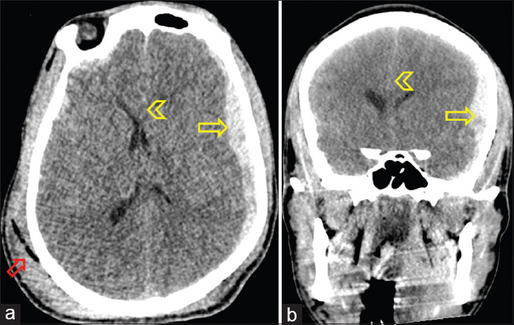 Camel-Related Head Injury in a High-Income Developing Country.