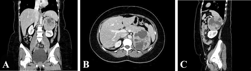 Aldosterone-Secreting Large Oncocytic Neoplasm of the Adrenal Gland with Borderline Potential.