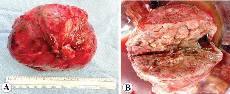 Aldosterone-Secreting Large Oncocytic Neoplasm of the Adrenal Gland with Borderline Potential.