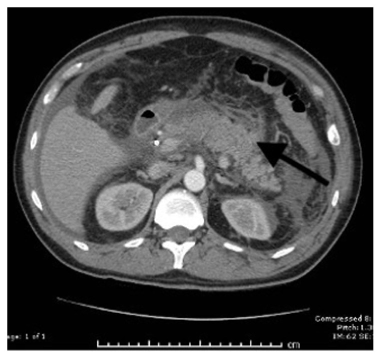 Acute Chest Pain in an Acute Complicated Pancreatitis with Severe Hypophosphatemia.